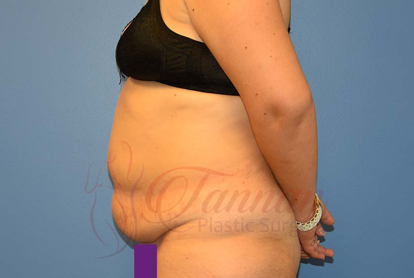 Reverse Upper Modified Lower Abdominoplasty Before & After Photos Raleigh  NC 27614