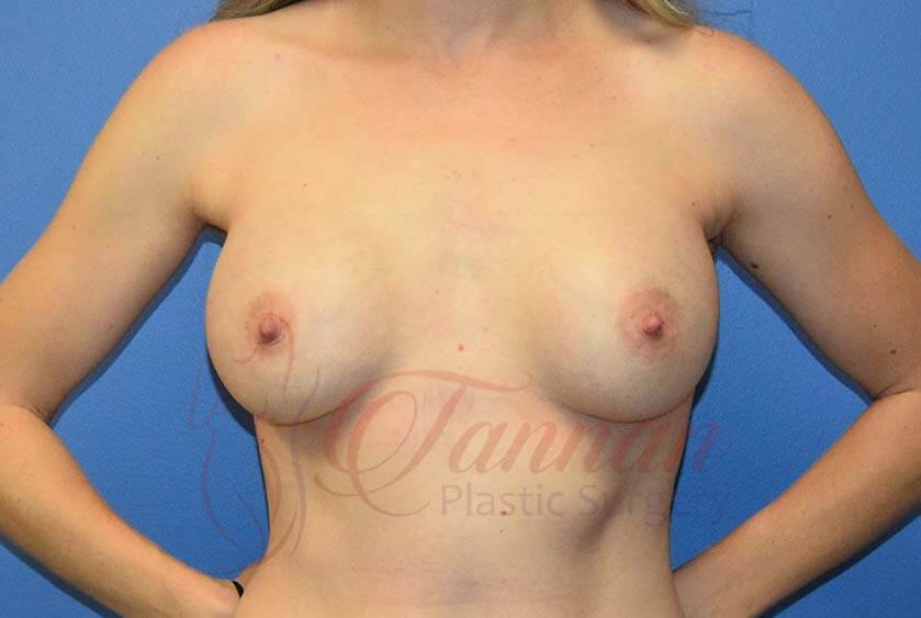 Breast-Augmentation-After-3101-Tannan-Plastic-Surgery