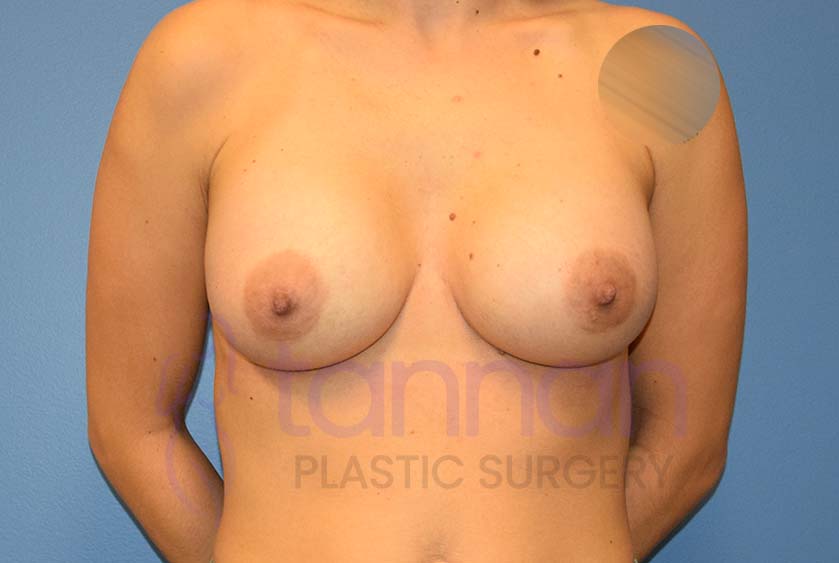 Breast-Augmentation-After-3301-Tannan-Plastic-Surgery