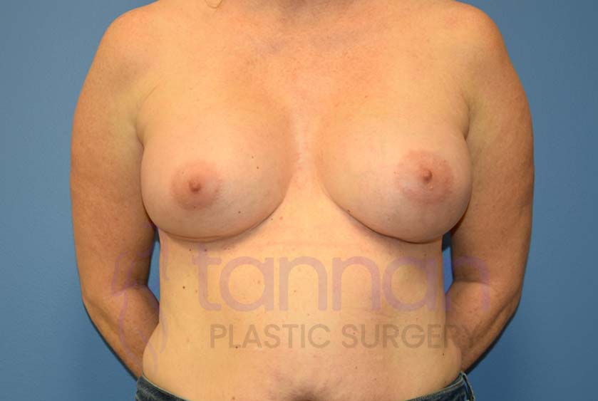Breast-Augmentation-After-3501-Tannan-Plastic-Surgery