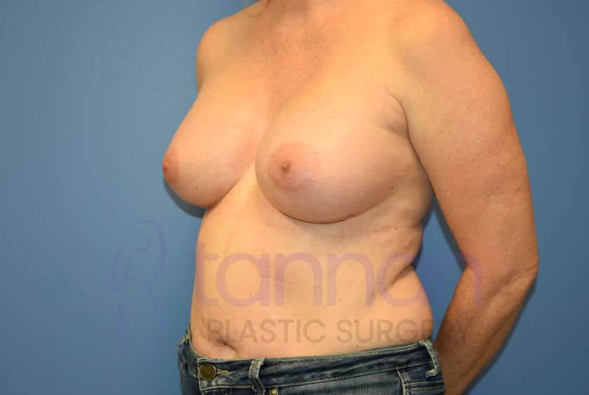 Breast-Augmentation-After-3502-Tannan-Plastic-Surgery