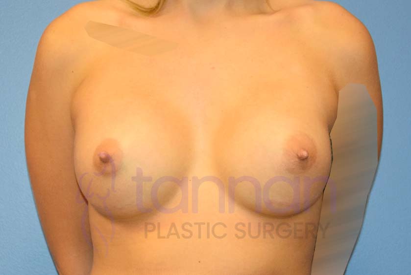Breast-Augmentation-After-3701-Tannan-Plastic-Surgery