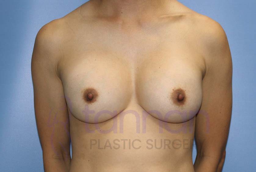 Breast-Augmentation-After-4201-Tannan-Plastic-Surgery