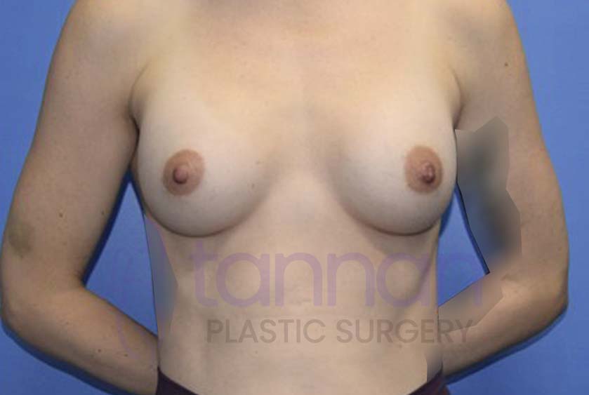 Breast-Augmentation-After-4401-Tannan-Plastic-Surgery