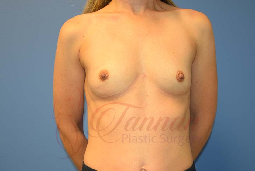 Breast-Augmentation-Before-2801-Tannan-Plastic-Surgery