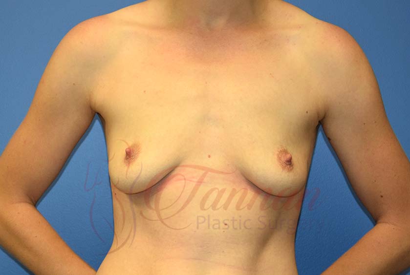 Breast-Augmentation-Before-3101-Tannan-Plastic-Surgery