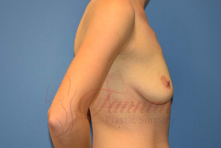 Breast-Augmentation-Before-3102-Tannan-Plastic-Surgery