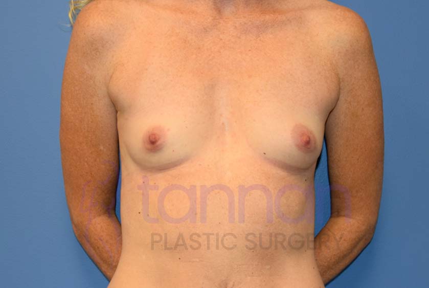 Breast-Augmentation-Before-3501-Tannan-Plastic-Surgery