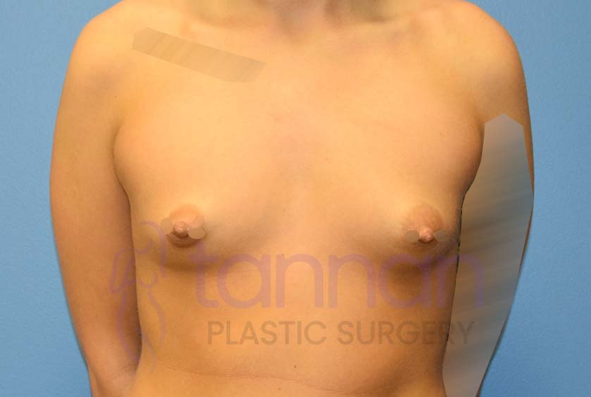 Breast-Augmentation-Before-3701-Tannan-Plastic-Surgery