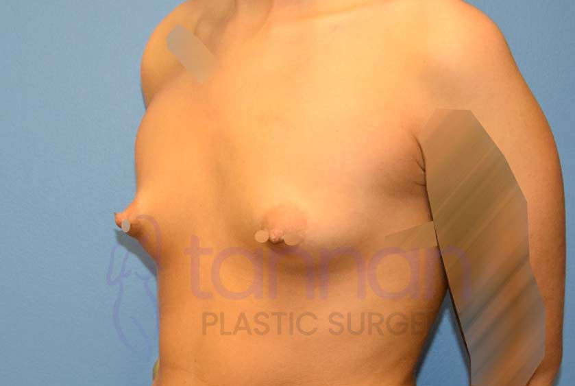 Breast-Augmentation-Before-3702-Tannan-Plastic-Surgery