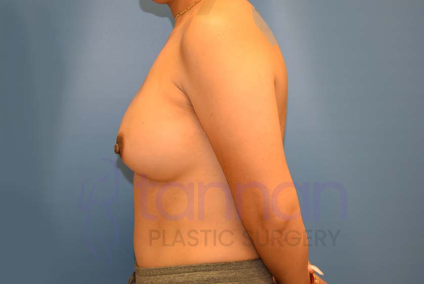 Breast-Augmentation-Before-4103-Tannan-Plastic-Surgery