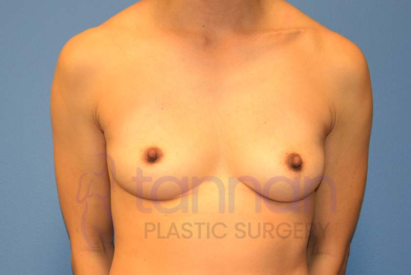 Breast-Augmentation-Before-4201-Tannan-Plastic-Surgery