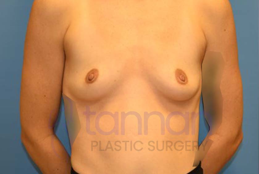 Breast-Augmentation-Before-4401-Tannan-Plastic-Surgery