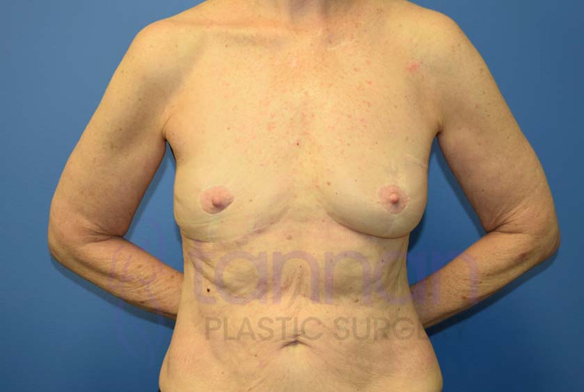Breast-Augmentation-Before-4501-Tannan-Plastic-Surgery
