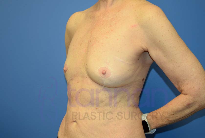 Breast-Augmentation-Before-4502-Tannan-Plastic-Surgery