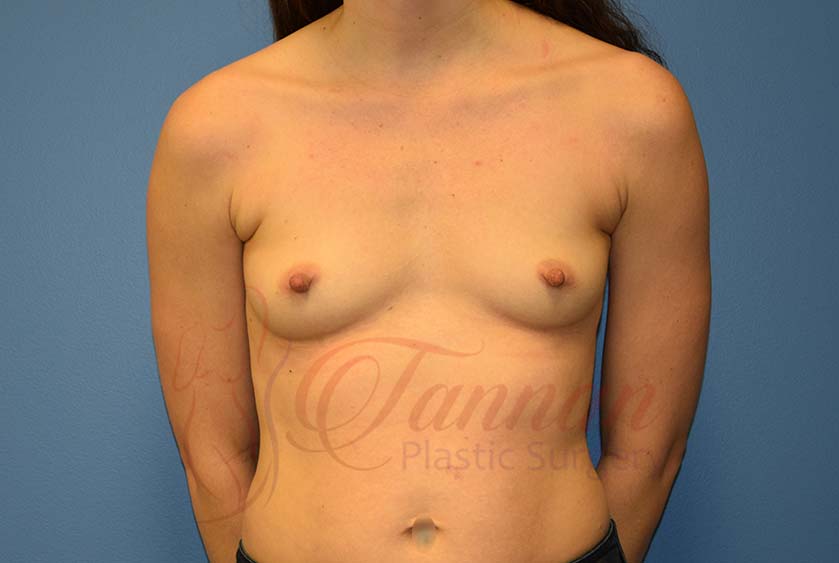 Breast-Augmentation-Before3201-Tannan-Plastic-Surgery