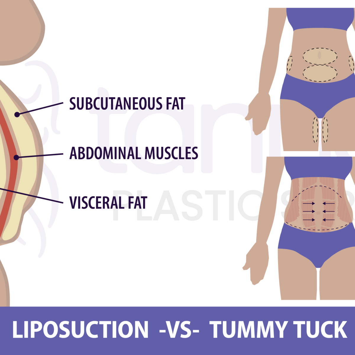 Is Laser Lipo Better Than a Tummy Tuck? - Tannan Plastic Surgery | Raleigh,  Chapel Hill, Durham, NC