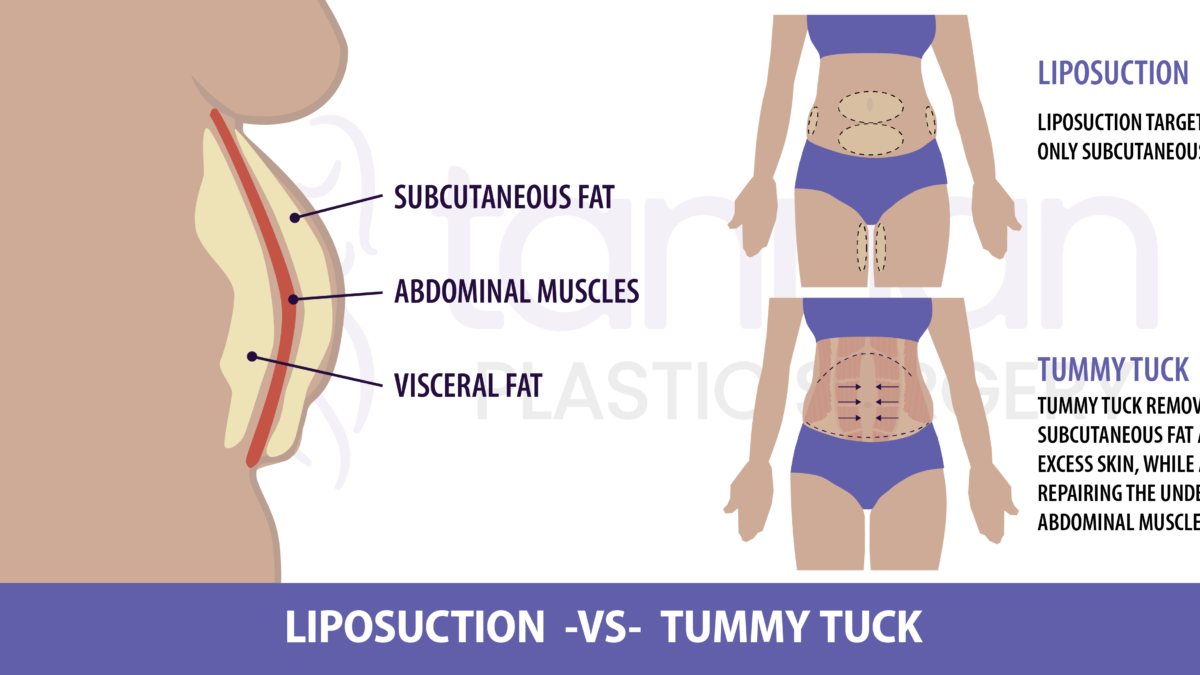lipo for c section pouch What Can I Do About My C-Section Scar and Pooch? - Tannan Plastic Surgery main image 1