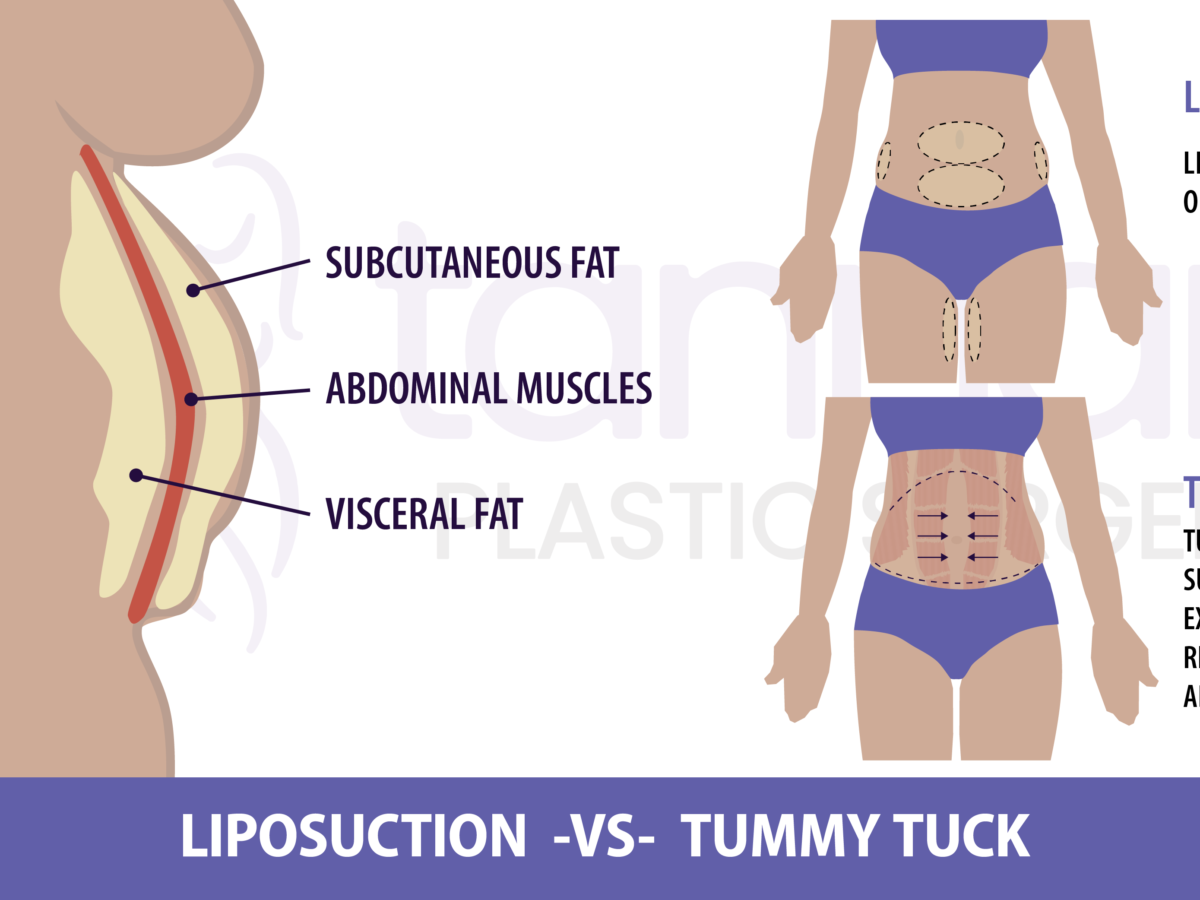 Is Laser Lipo Better Than a Tummy Tuck? - Tannan Plastic Surgery