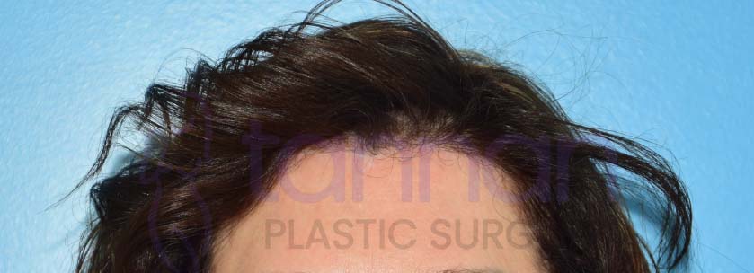 Closeup of hairline in browlift after photo