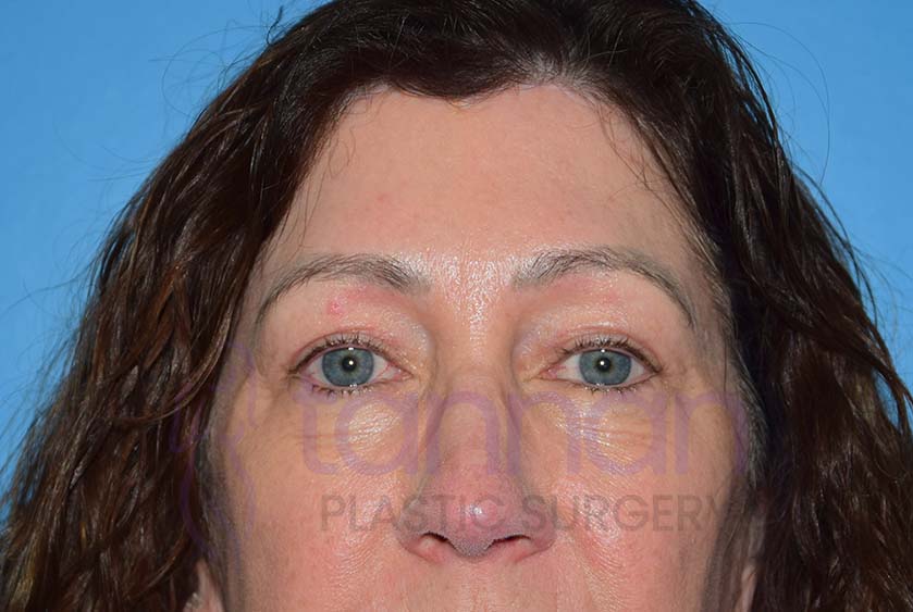 after browlift and blepharoplasty front view