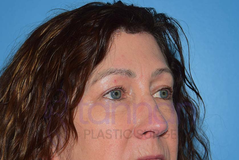 after browlift and blepharoplasty oblique view