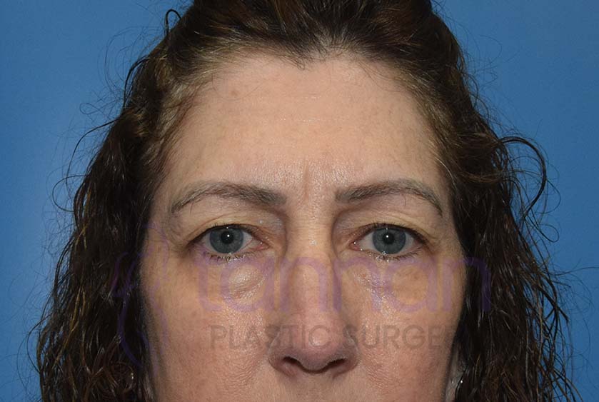 before browlift and blepharoplasty front view