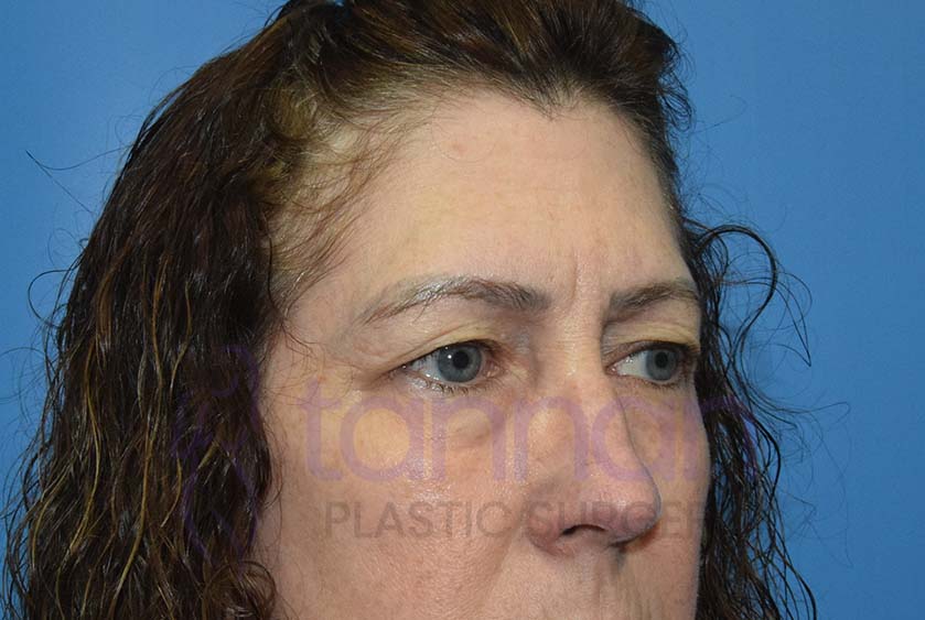before browlift and blepharoplasty oblique view