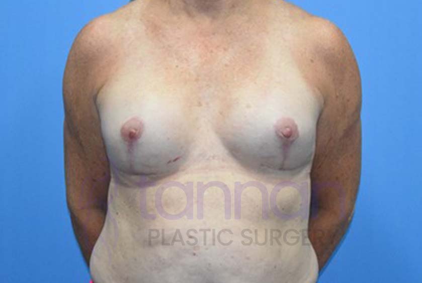 Breast-Augmentation-After-4301-Tannan-Plastic-Surgery