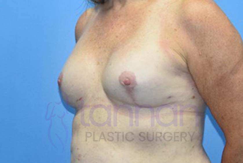 Breast-Augmentation-After-4302-Tannan-Plastic-Surgery