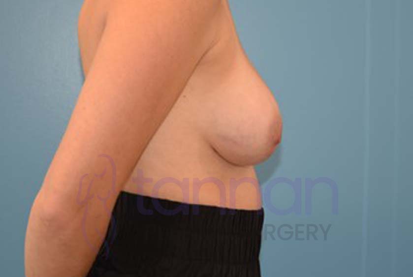 Breast-Augmentation-After-4702-Tannan-Plastic-Surgery