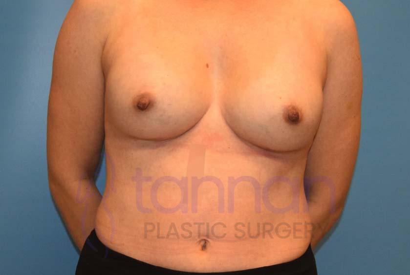 Breast-Augmentation-After-4801-Tannan-Plastic-Surgery