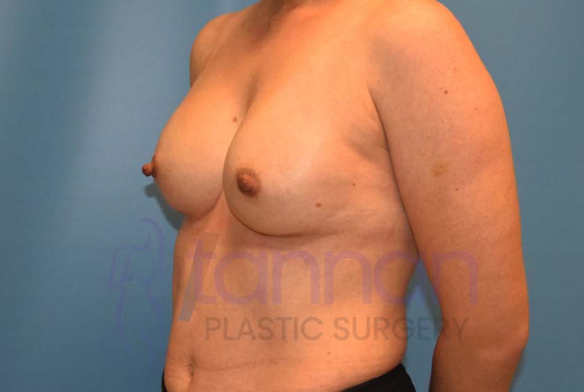Breast-Augmentation-After-4802-Tannan-Plastic-Surgery