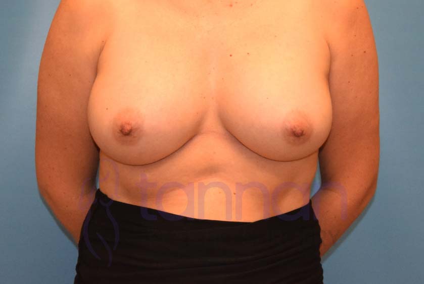 Breast-Augmentation-After-5301-Tannan-Plastic-Surgery