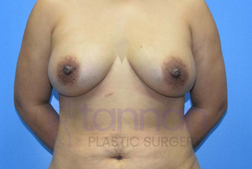 Breast-Augmentation-After-5701-Tannan-Plastic-Surgery