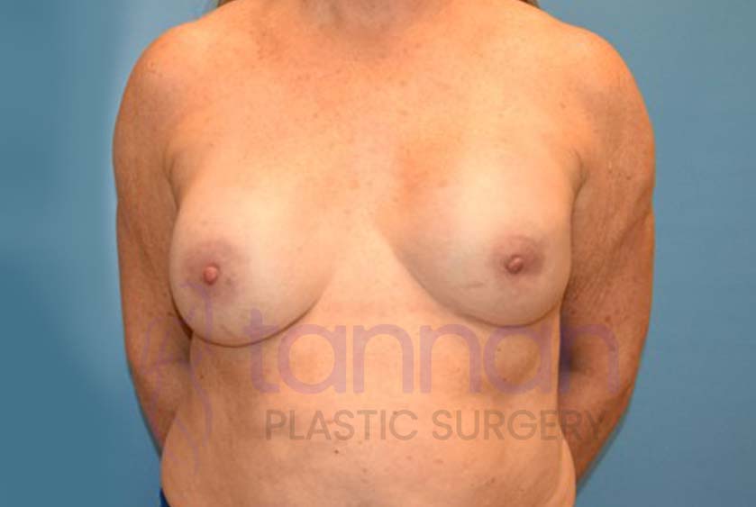 Breast-Augmentation-Before-4301-Tannan-Plastic-Surgery