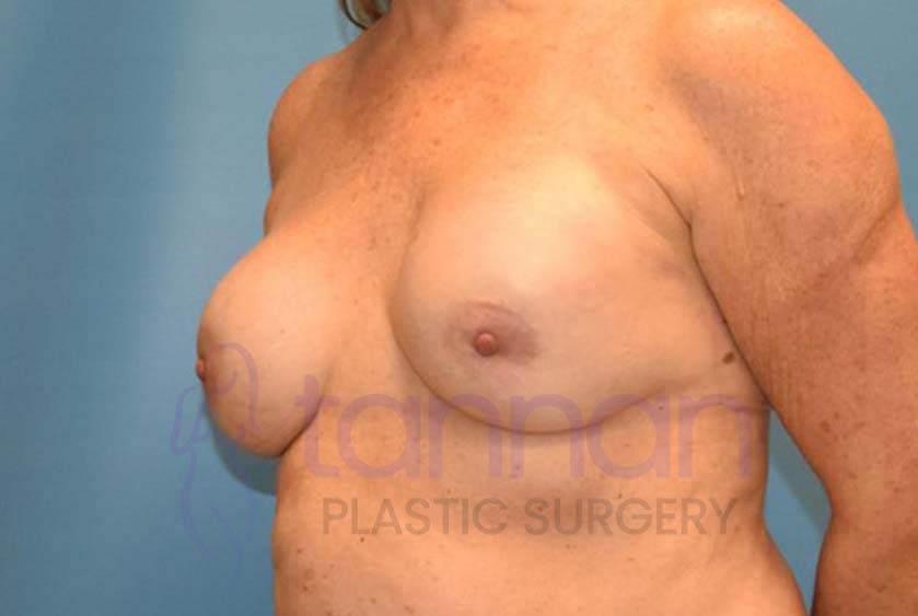 Breast-Augmentation-Before-4302-Tannan-Plastic-Surgery