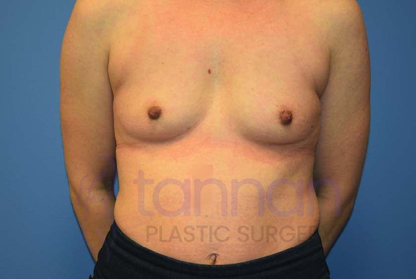 Breast-Augmentation-Before-4801-Tannan-Plastic-Surgery