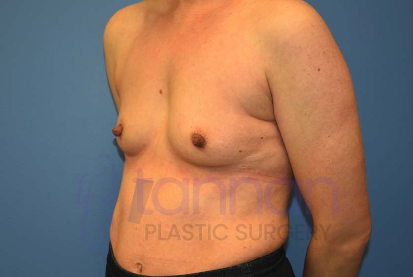 Breast-Augmentation-Before-4802-Tannan-Plastic-Surgery