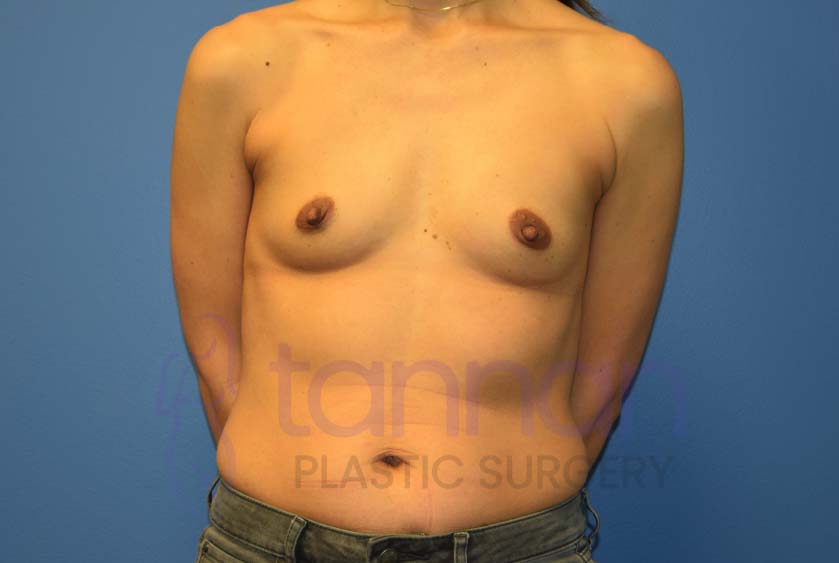 Breast-Augmentation-Before-4901-Tannan-Plastic-Surgery