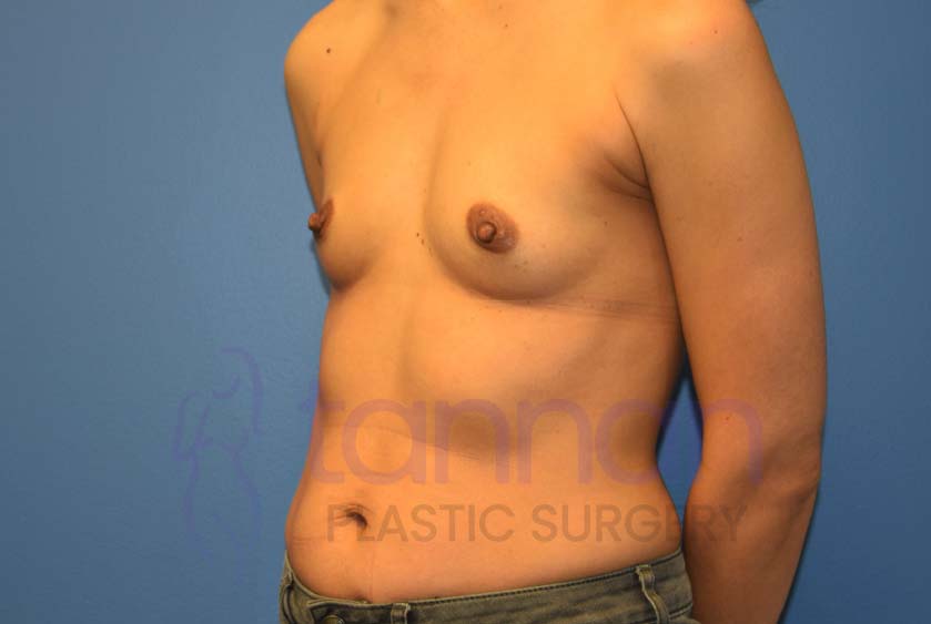 Breast-Augmentation-Before-4902-Tannan-Plastic-Surgery
