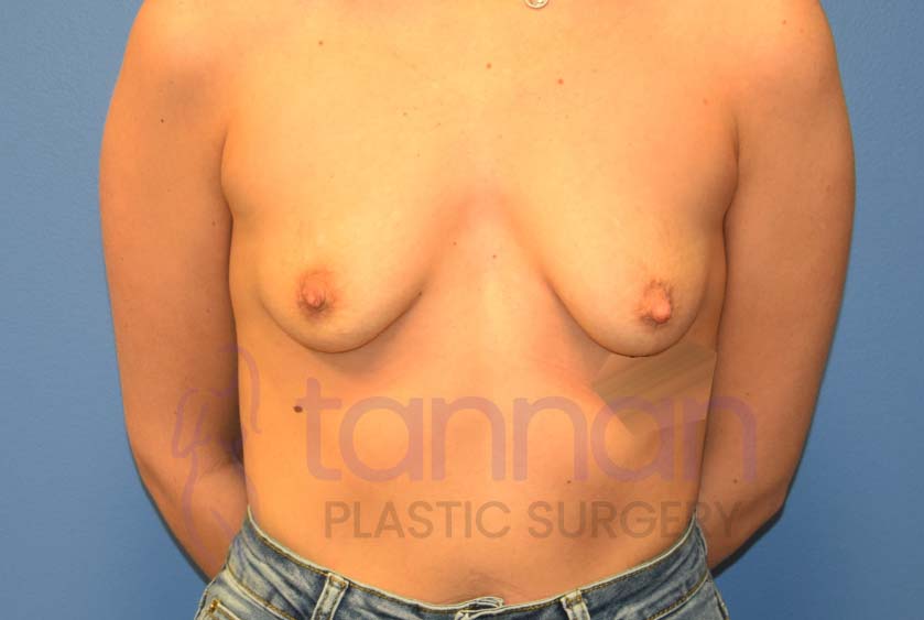 Breast-Augmentation-Before-5201-Tannan-Plastic-Surgery
