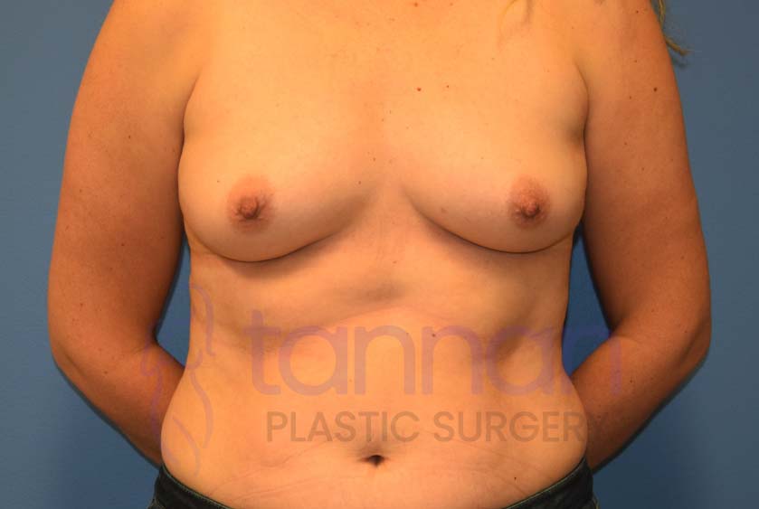 Breast-Augmentation-Before-5301-Tannan-Plastic-Surgery