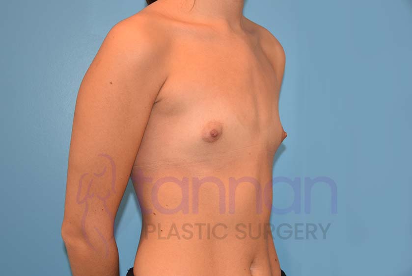 Breast-Augmentation-Before-5501-Tannan-Plastic-Surgery
