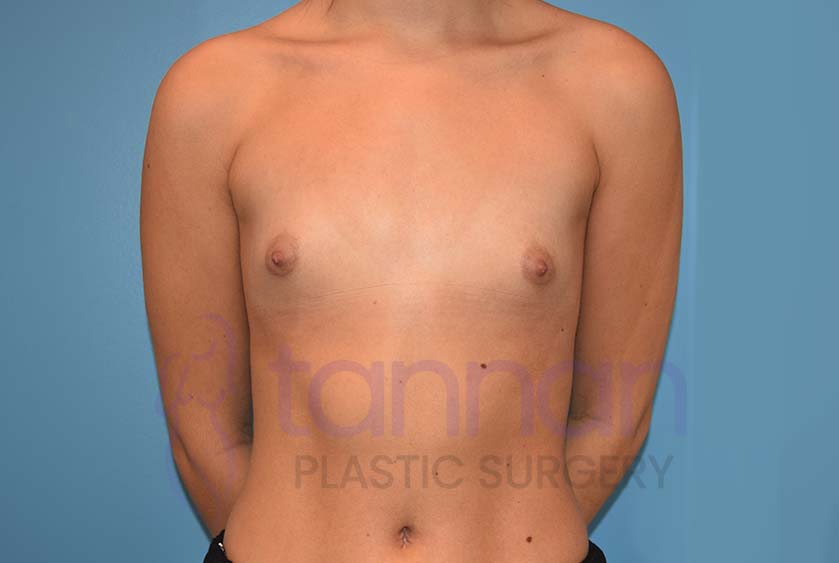 Breast-Augmentation-Before-5502-Tannan-Plastic-Surgery