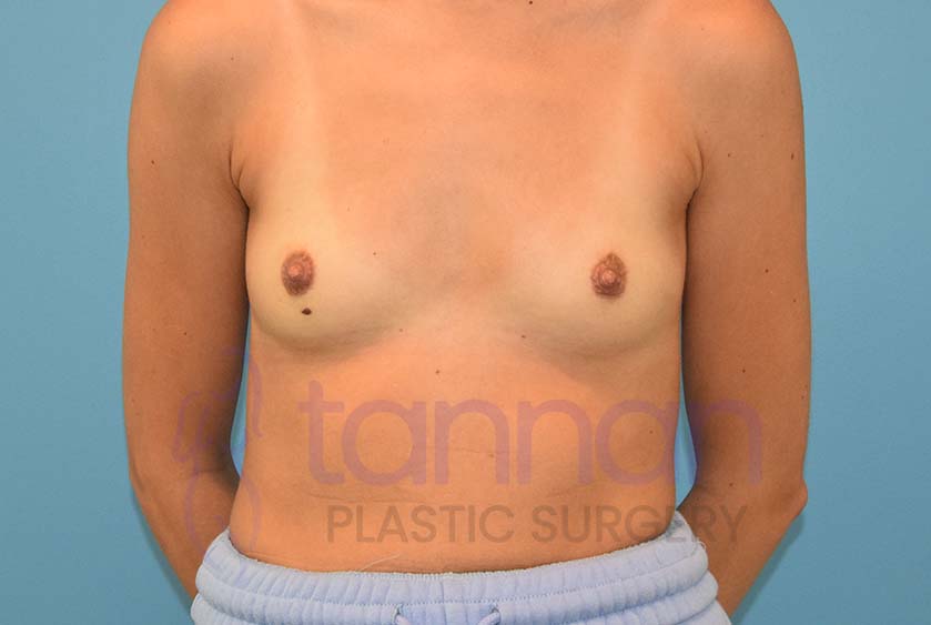 Breast-Augmentation-Before-5601-Tannan-Plastic-Surgery