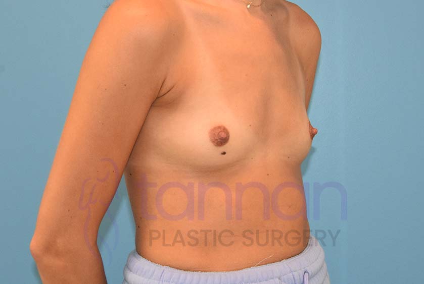 Breast-Augmentation-Before-5602-Tannan-Plastic-Surgery