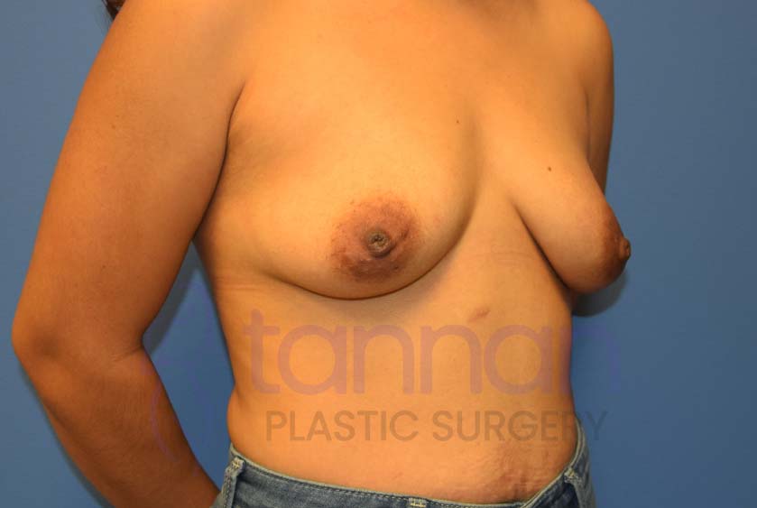 Breast-Augmentation-Before-5702-Tannan-Plastic-Surgery