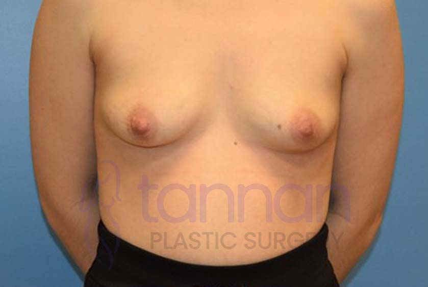 Breast-Augmentation-before-4701-Tannan-Plastic-Surgery