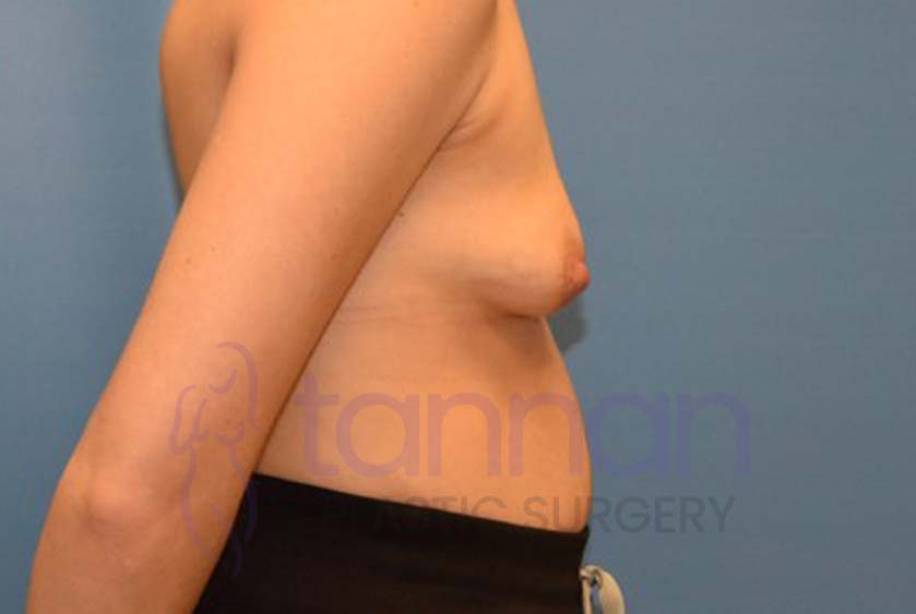 Breast-Augmentation-before-4702-Tannan-Plastic-Surgery